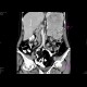 Carcinoma of pancreas, gigantic, liver metastases: CT - Computed tomography